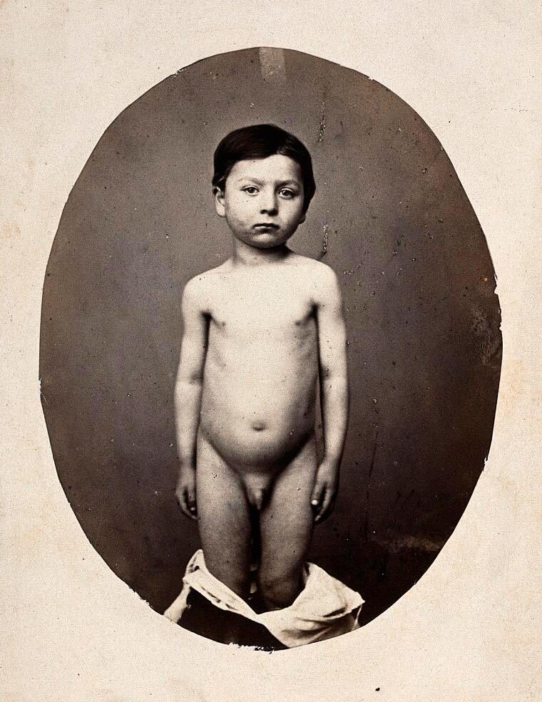 A standing child, naked; his shoulders are uneven (Стоящий ребенок, обнаженный; его плечи неровные), c.1865